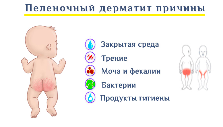 Классификация молочницы полости рта у детей